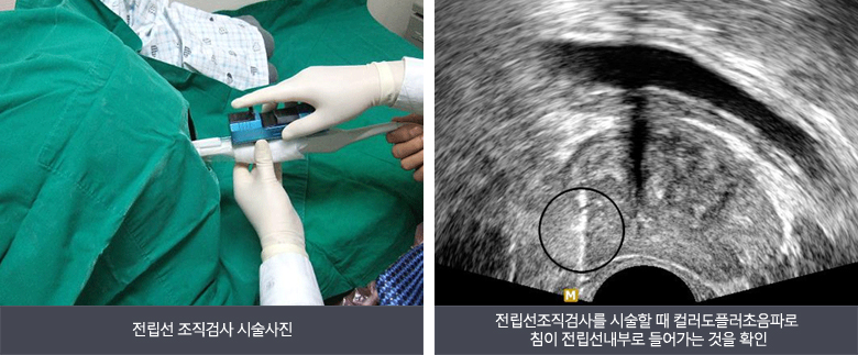 좌)전립선 조직검사 시술사진, 우)전립선조직검사를 시술할 때 컬러도플러초음파로 침이 전립선내부로 들어가는 것을 확인
